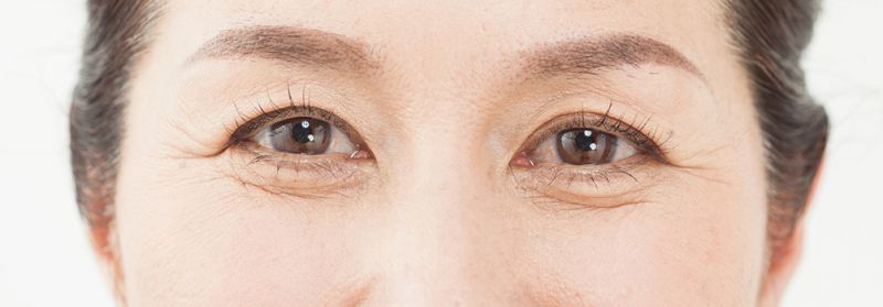 Nguyên nhân nào gây chảy xệ vùng da mắt?